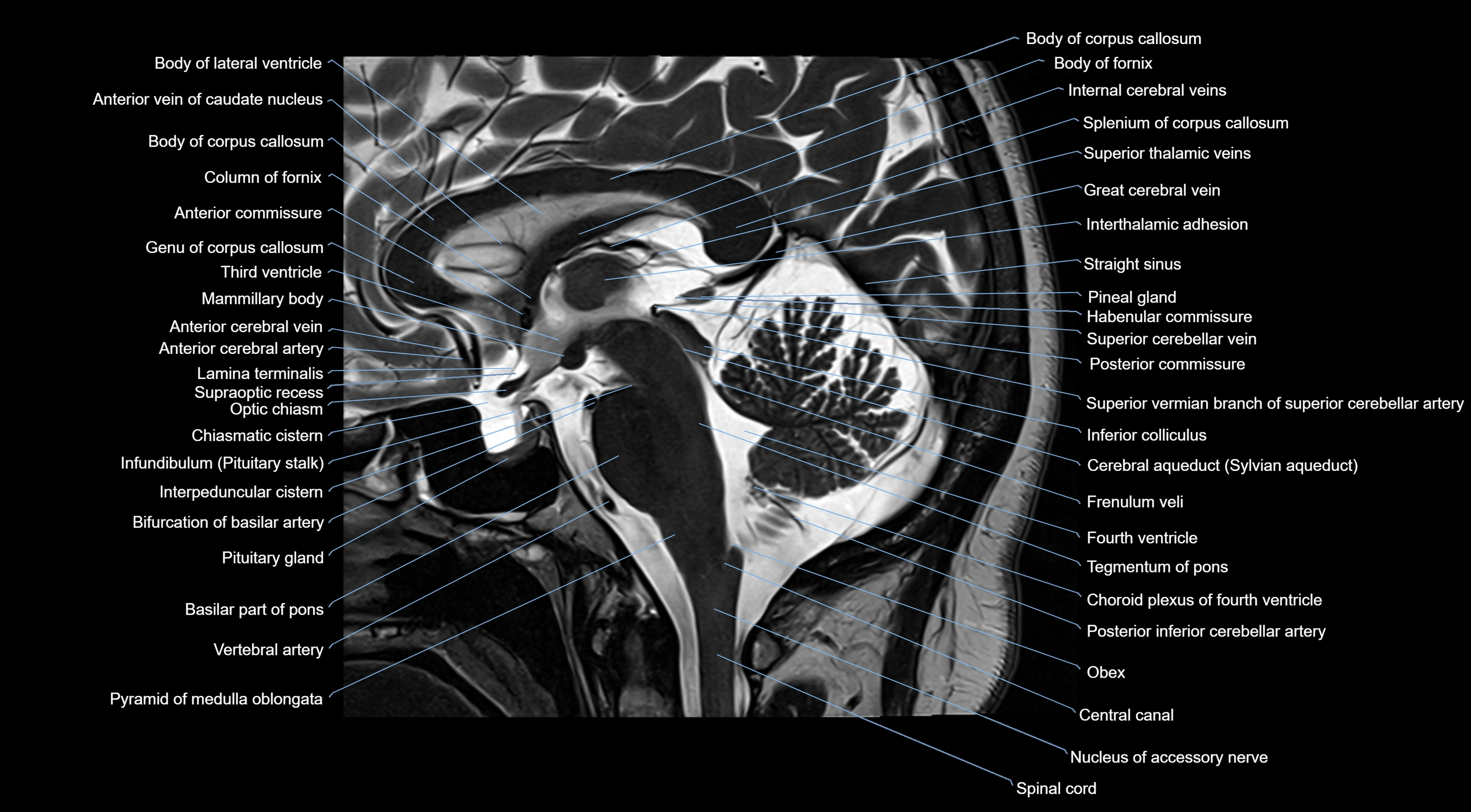 MRI brainstem & basal ganglia anatomy labelled  3T MRI images -img-10001-00024.webp